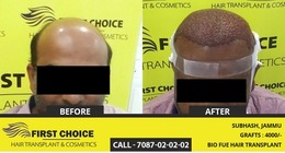 First Choice Hair Transplant & Cosmetics Ludhiana, Jalandhar, chandigarh & Panchkula